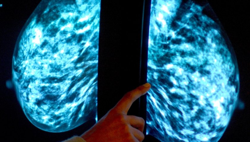 How a new cancer plan could save 20,000 lives a year by 2040