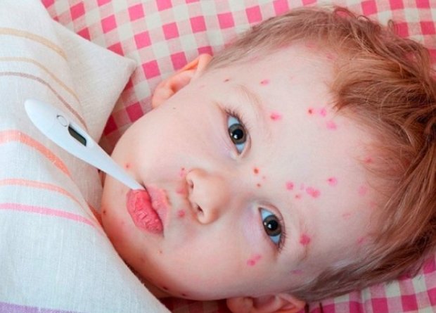 measles rash symptoms child vaccine