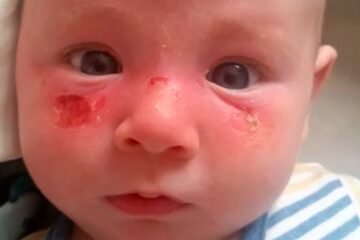 Mum’s Warning After Baby Gets Severe Sunburn in Scotland’s Cloudy Weather