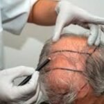 Hair Transplant Costs in Scotland Surge