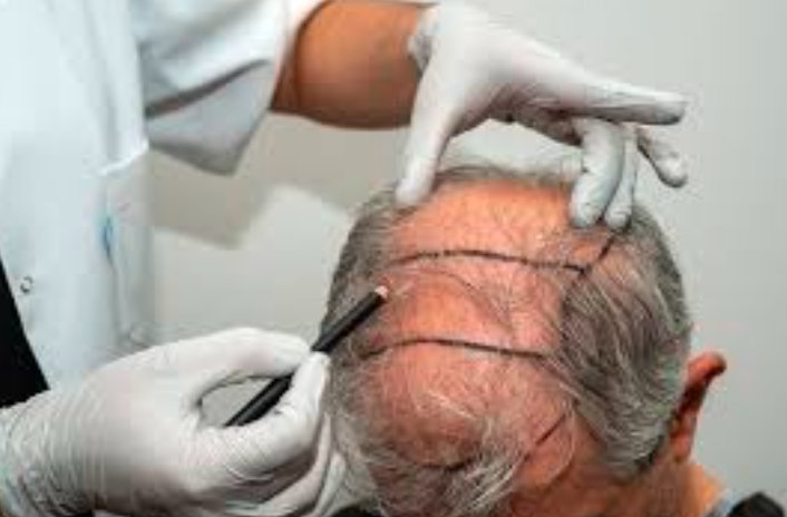 hair transplant procedure Scotland