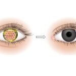 Scotland Approves Procysbi for Cystinosis Treatment