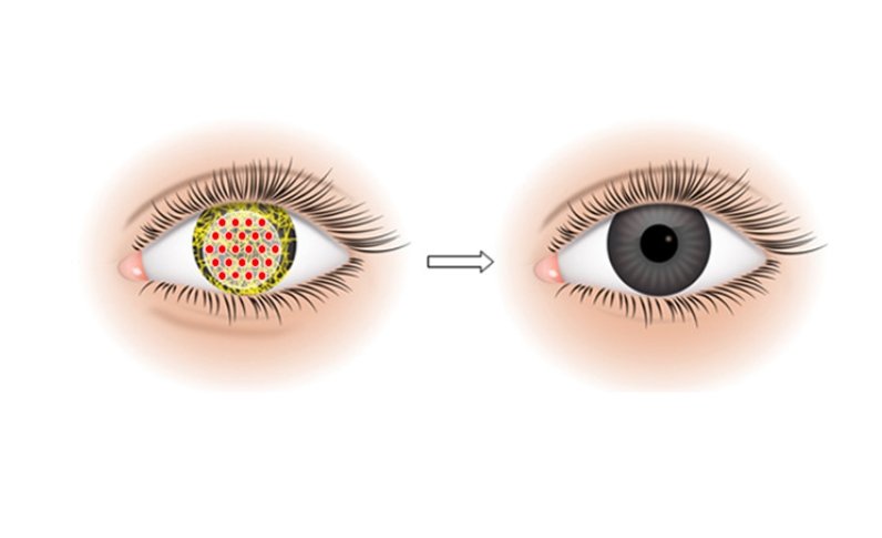 cystinosis treatment illustration