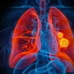 lung cancer screening