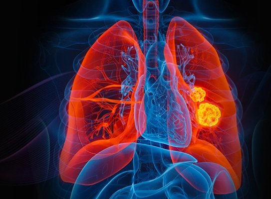 lung cancer screening