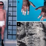 Procysbi Approved for NHS Scotland in Rare Kidney Disease