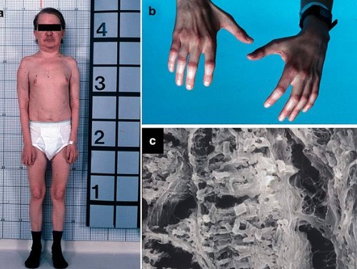 nephropathic cystinosis children treatment